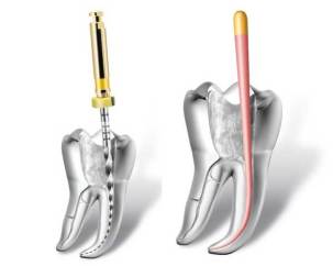 Rotary-Endodontics.jpg